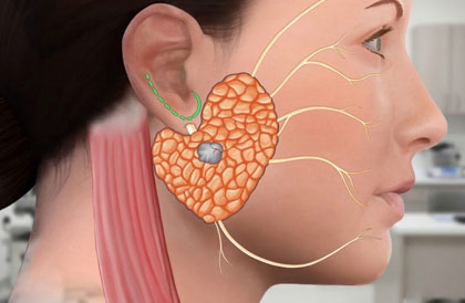 Salivary Gland Tumour Surgery