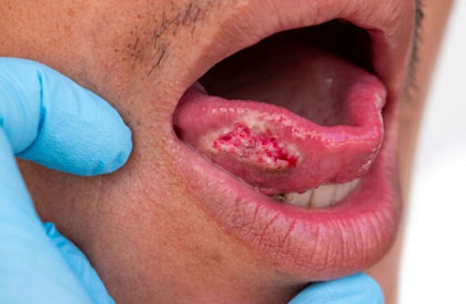 Tongue Cancer Surgery